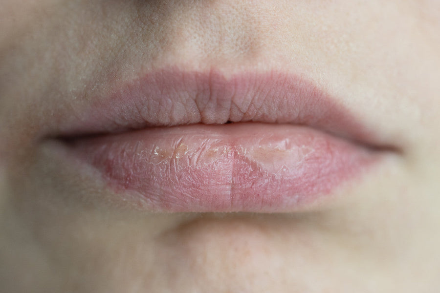 Cold-Air Chapped Lips and How to Treat Them Without a Lipstick Mess