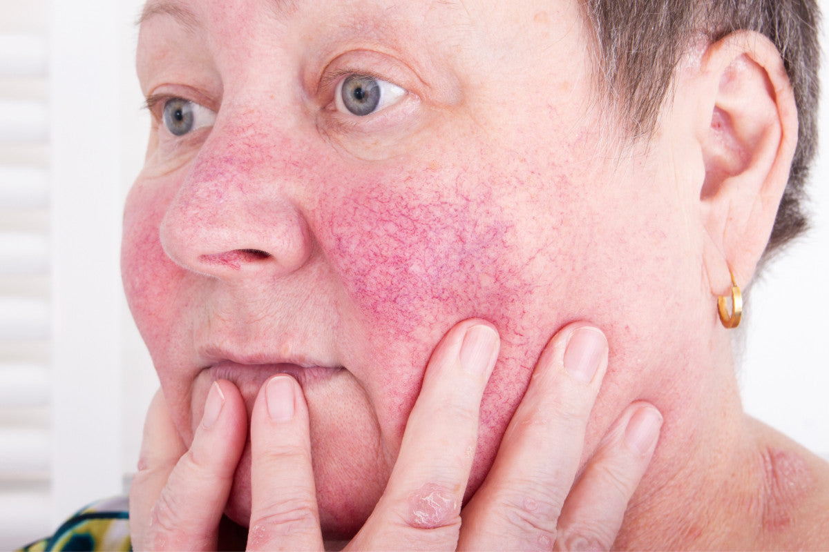 Skin Redness vs. Rosacea: Understanding and Managing Flare-Ups – Noche ...