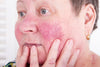 side-profile of an elderly woman with her hands on her face. she has very red cheeks from rosacea.