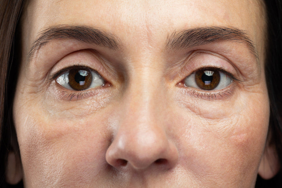 Why Under-Eye Puffiness Feels Worse as the Days Get Shorter