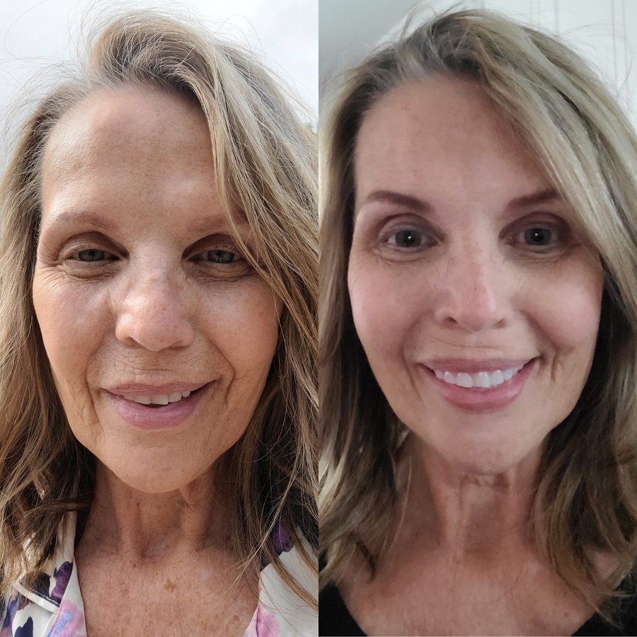 Before and after using the Vitamin C Serum
